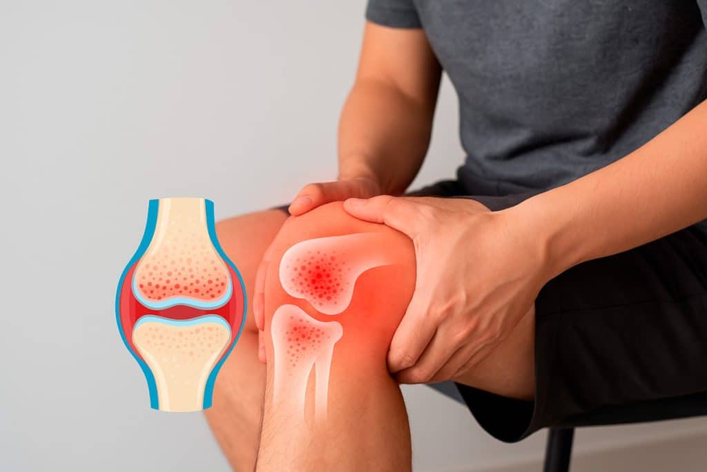 Edema óseo